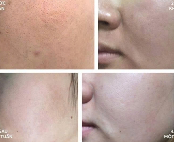 [Dr.Innoderm]_Dưỡng chất PN BOOST PLUS (PDRN & HA)_Sản phẩm chính hãng_Xuất VAT 100%